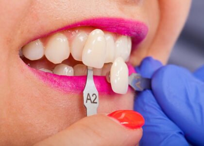 Veneers: Enhancing Dental Aesthetics with Thin Ceramic Coatings