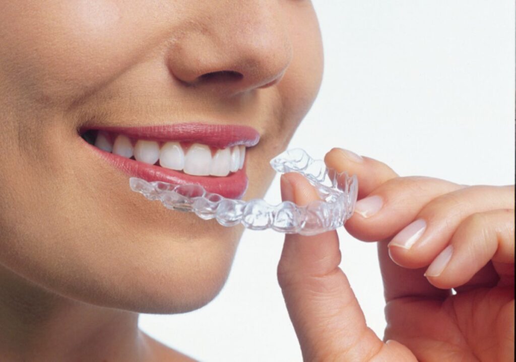Invisible Retainers: The Use of Transparent Removable Appliances to Correct and Hold the Position of Teeth