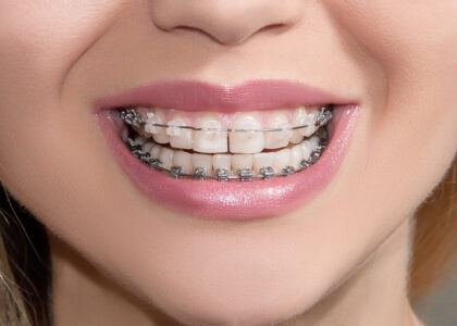 Braces: Correction of the Position of the Teeth with Metal or Transparent Braces